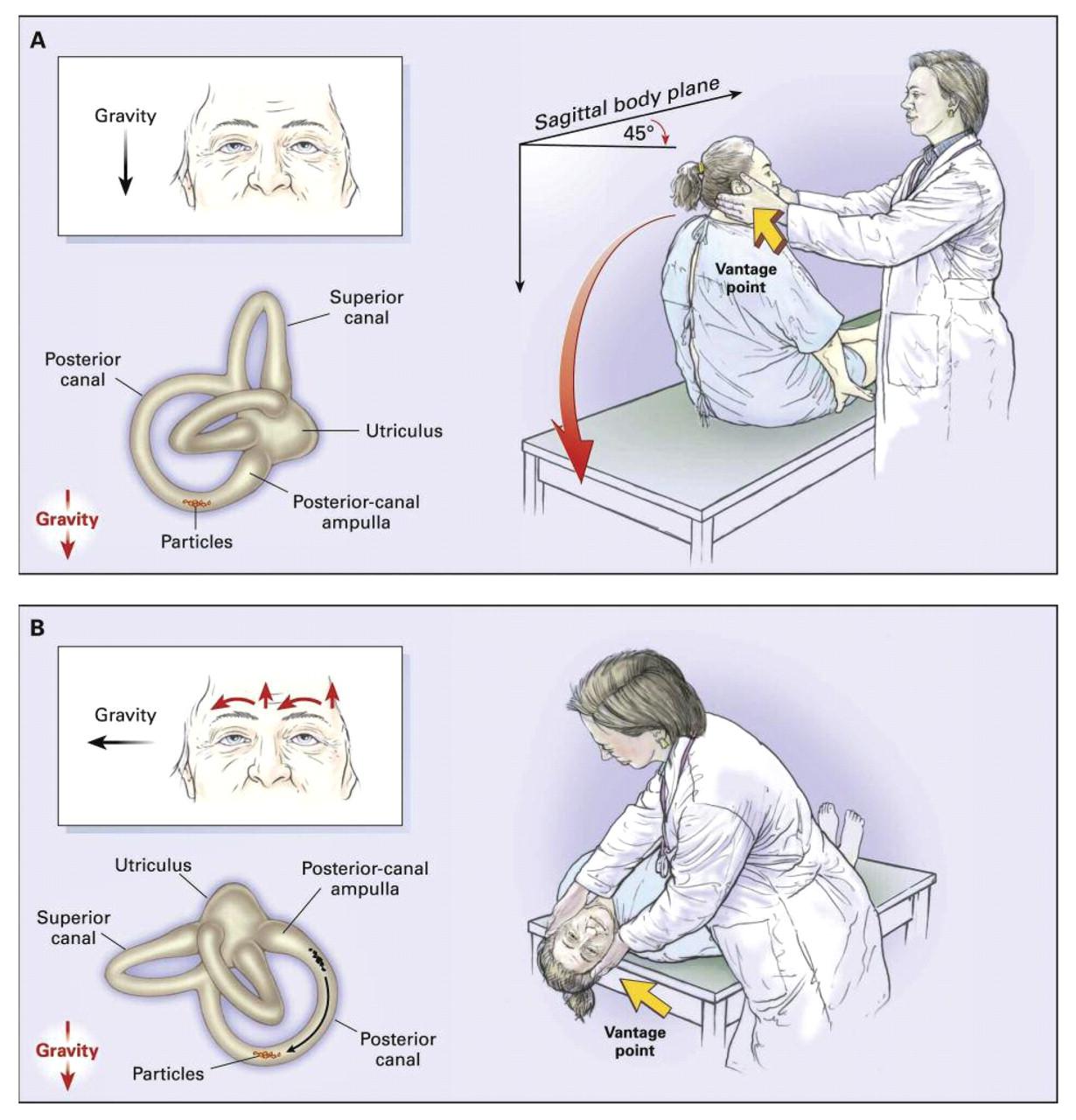 Dix-Hallpike positional test for BPPV with inset showing posterior semicircular canal involvement