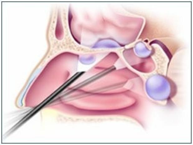 Diagnostic nasal endoscopy being performed in an ENT clinic to assess the sinus drainage pathways