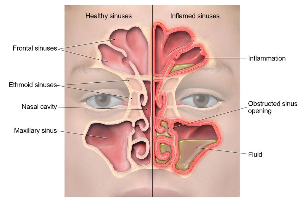 Labelled anatomy of the paranasal sinuses showing frontal, ethmoid, maxillary, and sphenoid sinuses with their drainage pathways
