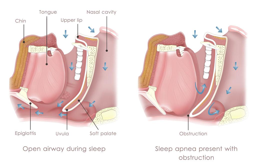 Diagram comparing an open airway during sleep with airway obstruction in sleep apnea