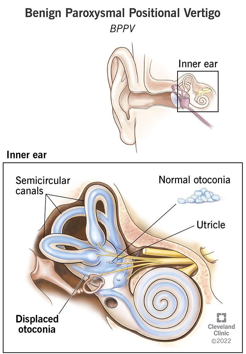 Repositioning manoeuvre sequence for BPPV
